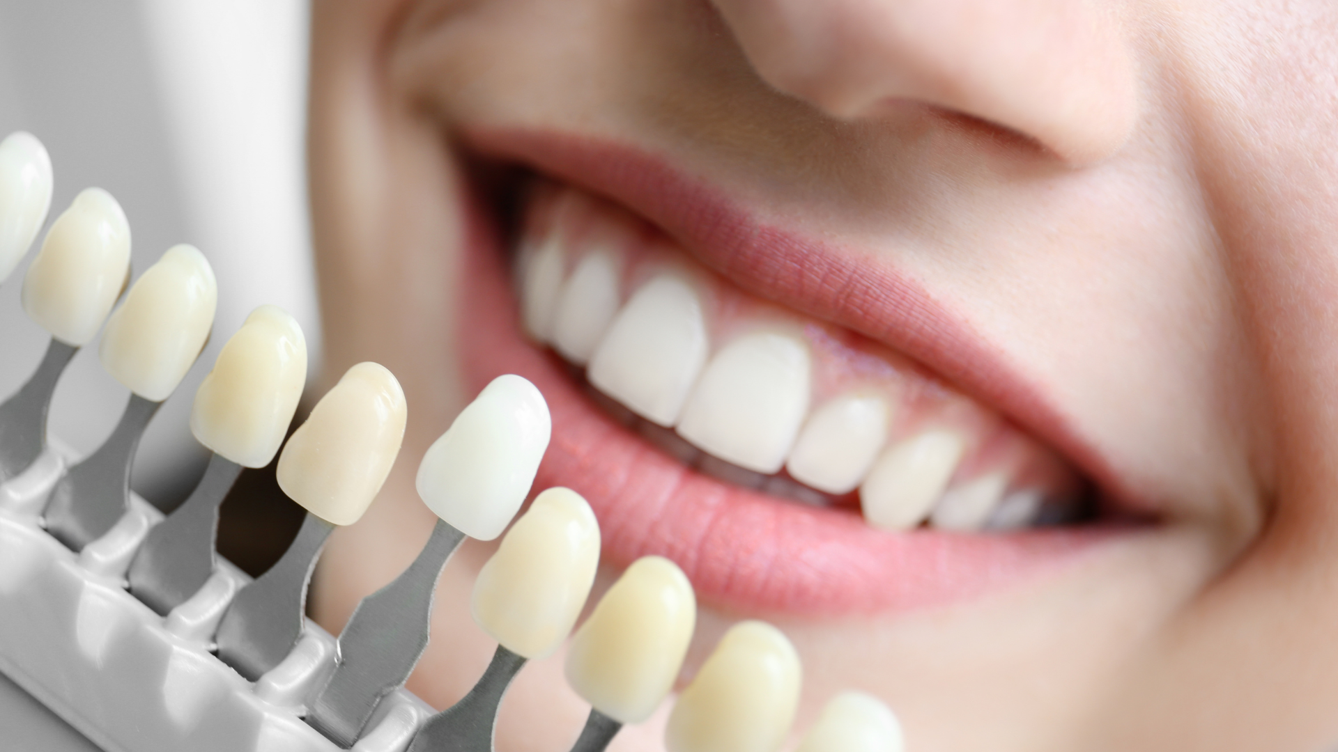 Achieving a Brighter Smile: Best Teeth Whitening Practices